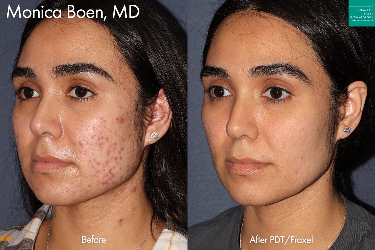 Acne Scar Reduction