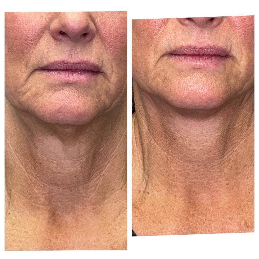Botox/Thread Lift Combo